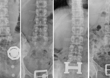 4 şüphelinin midesinden 121 kesim eroin çıktı
