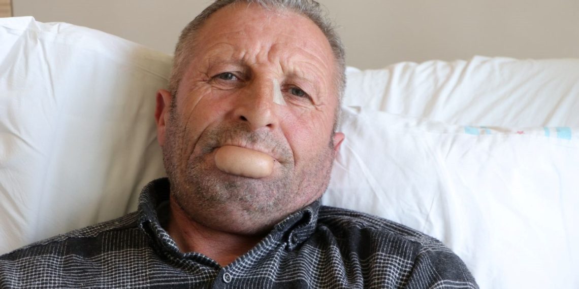 Dudak yarası kanser çıktı, kol derisinden yenisi yapıldı