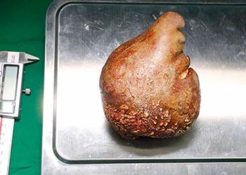 Dünyanın en büyük böbrek taşı çıkarıldı: 801 gram yükünde