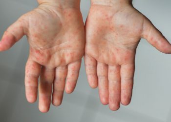 Kızamık olaylarında korkutan artış: İstanbul’da 2 çocuk hayatını kaybetti