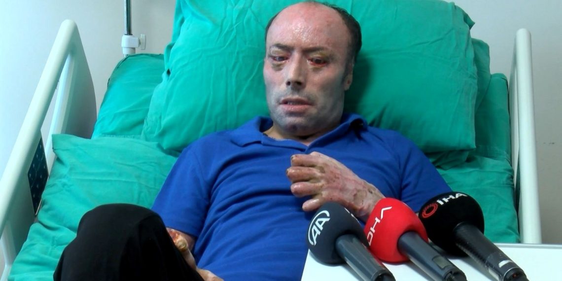 Maden kazasında ağır yaralanmıştı, 8 ay sonra taburcu edildi