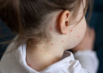 Sıhhat Bakanlığı’ndan 81 ile “kızamık” yazısı