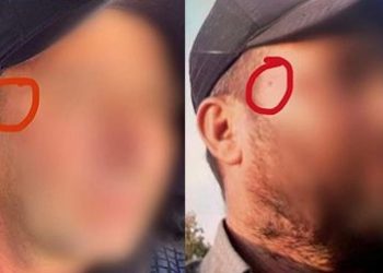 Uyuşturucu şüphelisinden akılalmaz hareket: Yakalanmamak için şakağındaki beni aldırdı