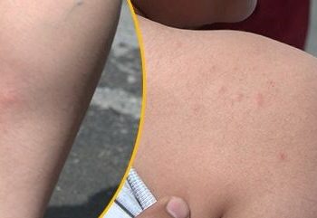 “Aedes Aegypti” tedirginliği artıyor | Bilim Şurası Üyesi Alper Şener’den “kolonya sürmeyin” uyarısı