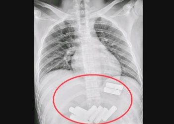 Çin’de bir kişinin yuttuğu 11 pil, endoskopiyle midesinden çıkarıldı