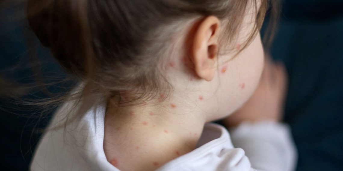 İstanbul’un en çok hangi bölgeleri kızamık tehlikesi altında? 8-10 yıl sonra ölümcül risk uyarısı