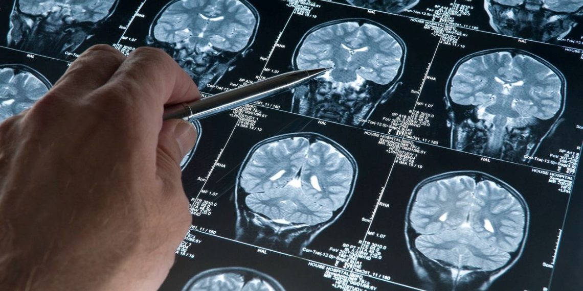 Alzheimerın sırrı çözülüyor mu? Beyin hücrelerinin nasıl öldüğü keşfedilmiş olabilir
