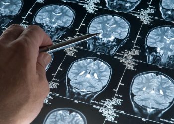 Alzheimerın sırrı çözülüyor mu? Beyin hücrelerinin nasıl öldüğü keşfedilmiş olabilir