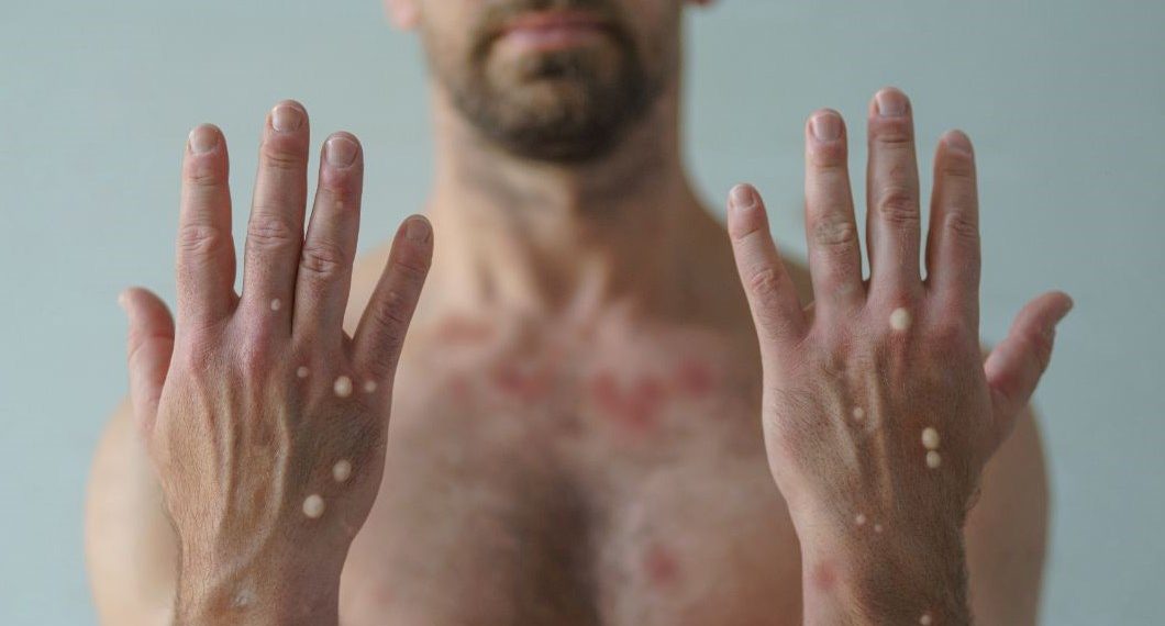 DSÖ: Dünya genelinde 90 binden fazla maymun çiçeği virüsü hadisesi görüldü