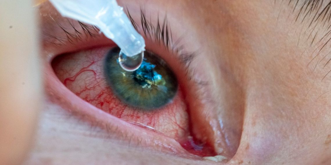 Pakistan’da bulaşıcı ‘kırmızı göz’ hastalığına yakalananların sayısı 86 bini geçti