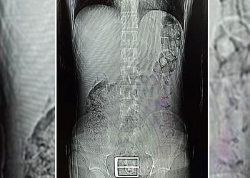 Polis şüphelenip durdurdu, midesinden ve bağırsaklarından uyuşturucu çıktı