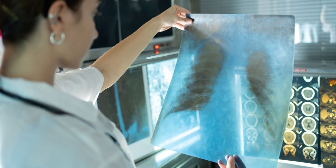 Dünyanın ikinci ölümcül bulaşıcı hastalığı tüberküloz 7,5 milyon bireyde görüldü