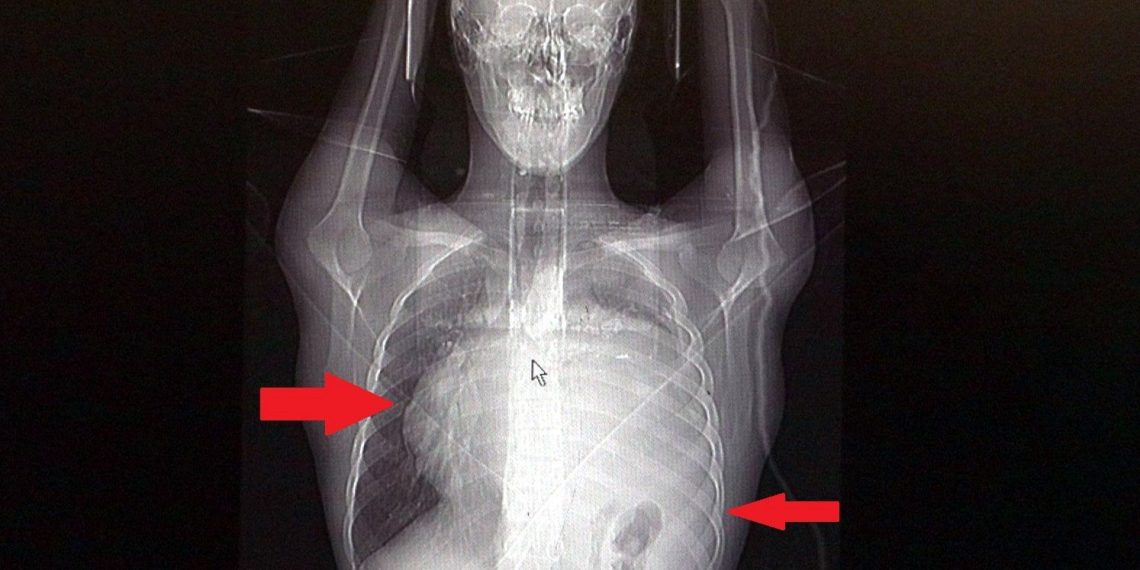 İstanbul’da hekimler bile şaşıran vaka! Kalbi 12 santim sağa kaydı