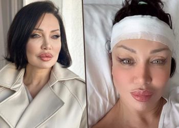 Estetik operasyonda yeni trend: Umut Akyürek alnını daralttı