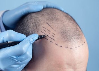 Uzmanı açıkladı: Yenilikçi teknolojiyle 1 seansta 7 bin 500 saç teli nakli yapabiliyoruz