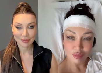 Alın daraltma ameliyatı olan Umut Akyürek son halini paylaştı