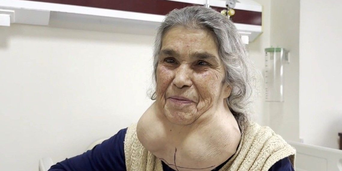 Tabip dehşetinden 50 yıl bu türlü yaşadı! (Guatr belirtileri ve tedavi yöntemleri)