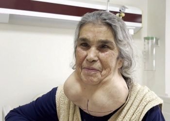 Tabip dehşetinden 50 yıl bu türlü yaşadı! (Guatr belirtileri ve tedavi yöntemleri)
